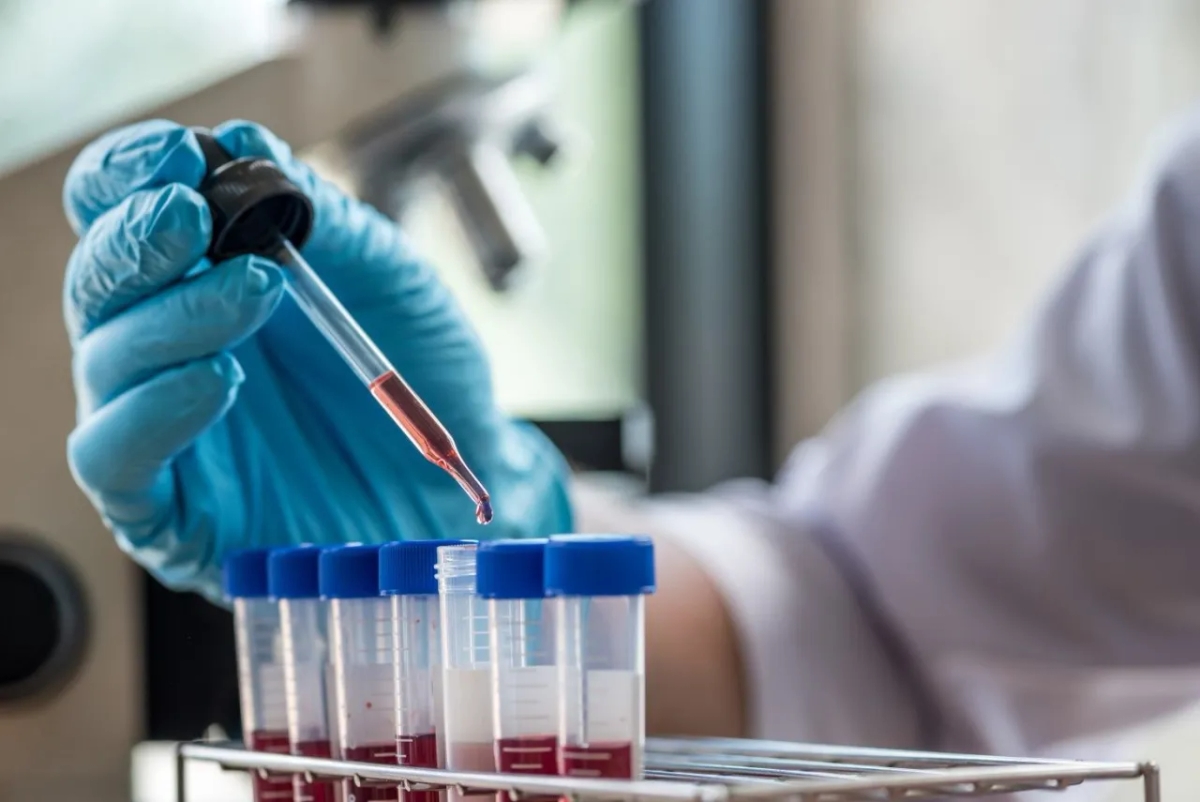 Ile kosztuje test na HIV w laboratorium? Sprawdź ceny i opcje darmowe