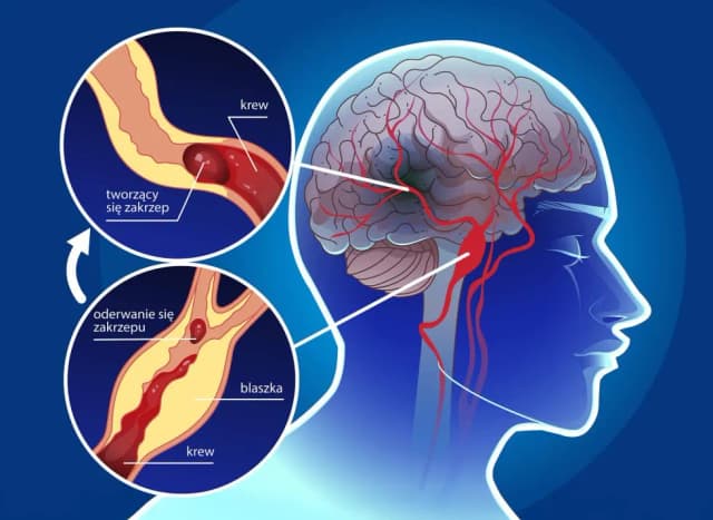 PFO objawy neurologiczne: Jak unikać ryzyka udaru mózgu? PFO objawy neurologiczne: Jak unikać ryzyka udaru mózgu?