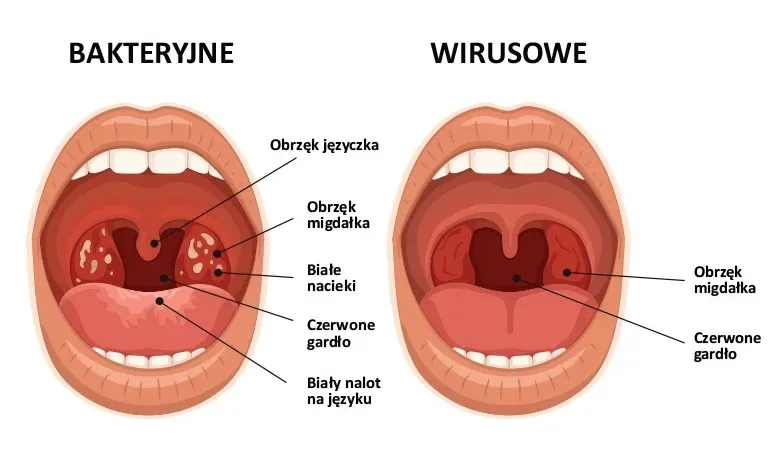 Jakie leki na anginę ropną? Skuteczne metody leczenia i ulgi