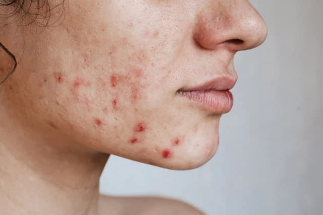 Trądzik hormonalny jakie badania: Kluczowe testy, które musisz znać Trądzik hormonalny jakie badania: Kluczowe testy, które musisz znać