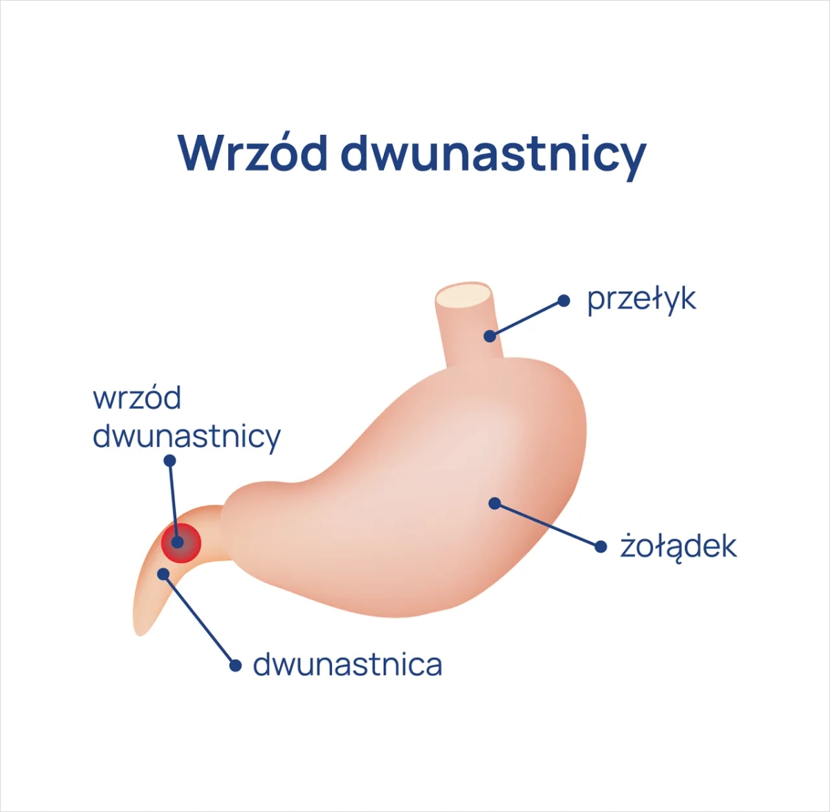 Jakie są objawy wrzodu dwunastnicy? Poznaj niebezpieczne sygnały