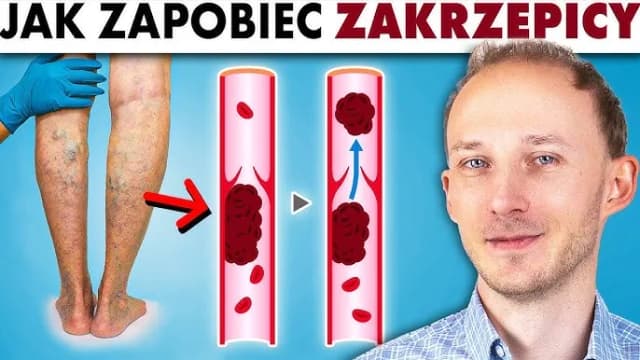 Zakrzepica jaki lekarz: jak uniknąć błędnych decyzji medycznych Zakrzepica jaki lekarz: jak uniknąć błędnych decyzji medycznych