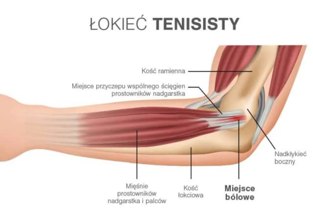 Ból łokcia tenisisty: objawy, które mogą zaskoczyć każdego