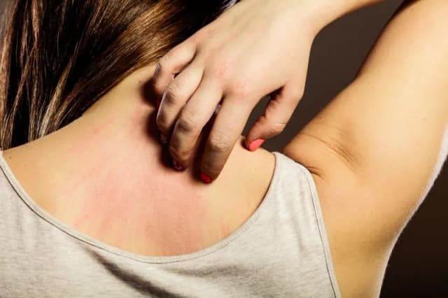 Nietolerancja histaminy objawy skórne – jak je rozpoznać i leczyć