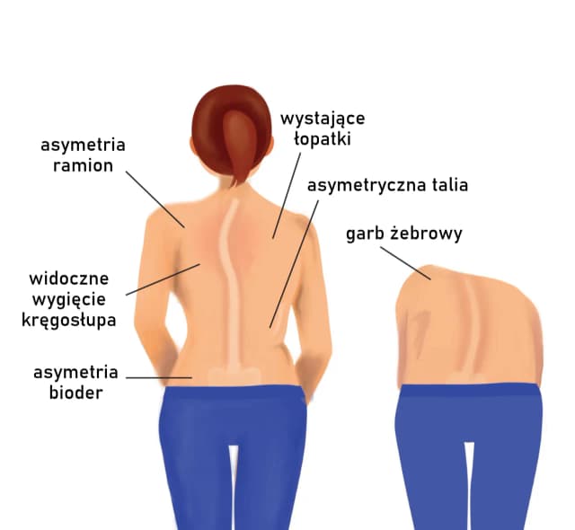 Skolioza u dorosłych objawy: Jak rozpoznać i uniknąć powikłań Skolioza u dorosłych objawy: Jak rozpoznać i uniknąć powikłań
