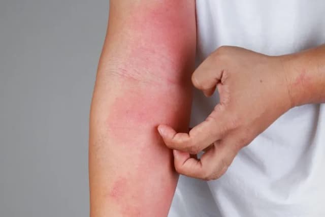 Nietolerancja fruktozy objawy skórne - rzadkie symptomy, które zaskakują Nietolerancja fruktozy objawy skórne - rzadkie symptomy, które zaskakują
